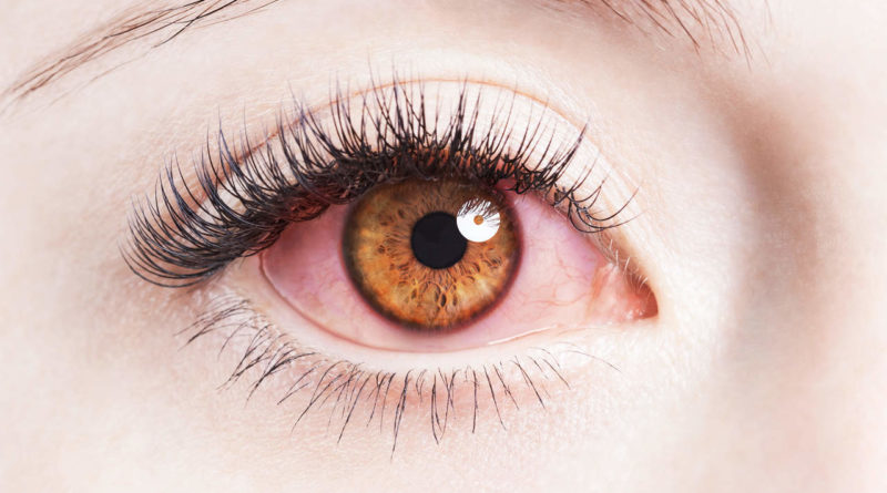 Why-Your-Contact-Lenses-Are-Giving-Red-Eyes