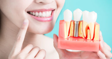 How to Whiten Natural Teeth Together with Implants