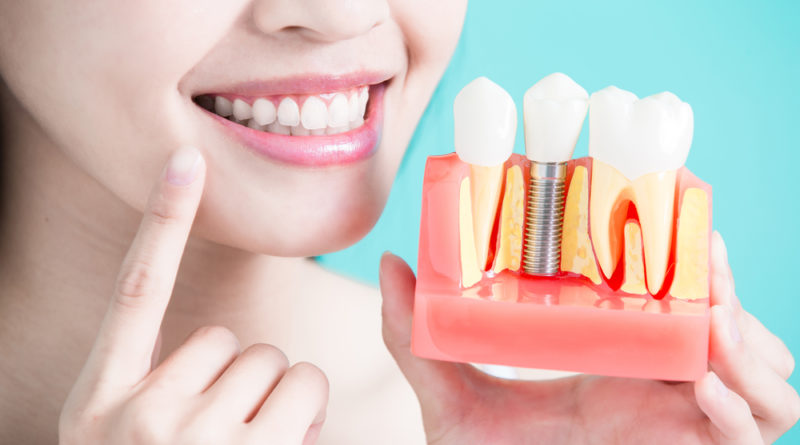 How to Whiten Natural Teeth Together with Implants