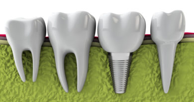 dental implant technology