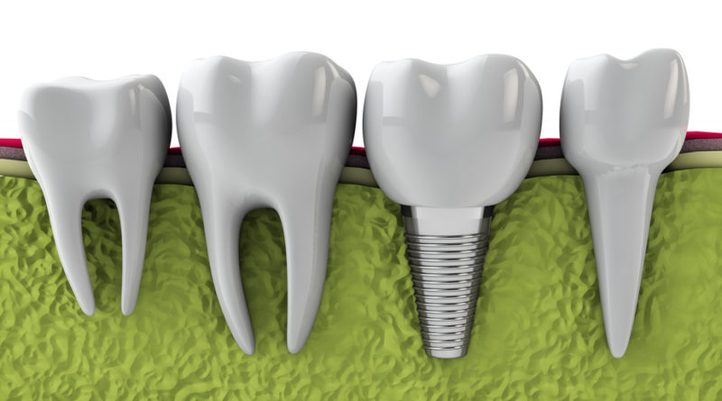 dental implant technology