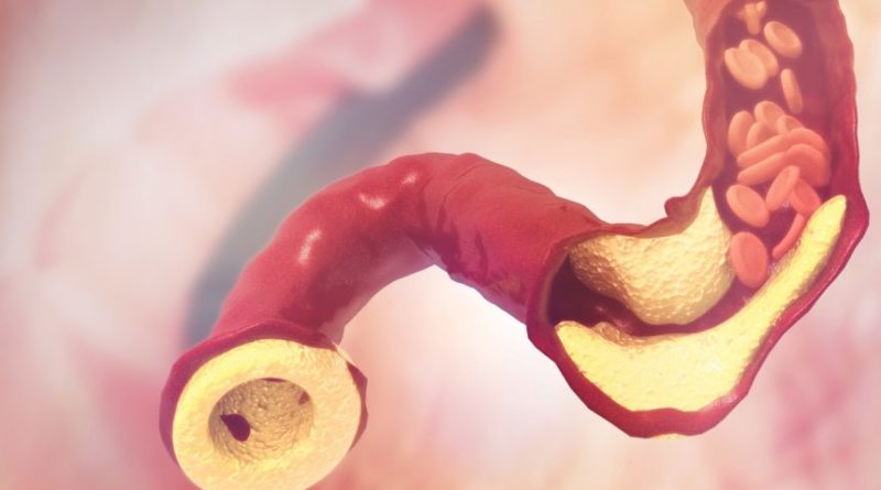 Natural Remedies For Preventing ASCVD Risk