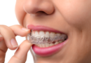 Who Can Get Invisalign and What Are the Benefits?