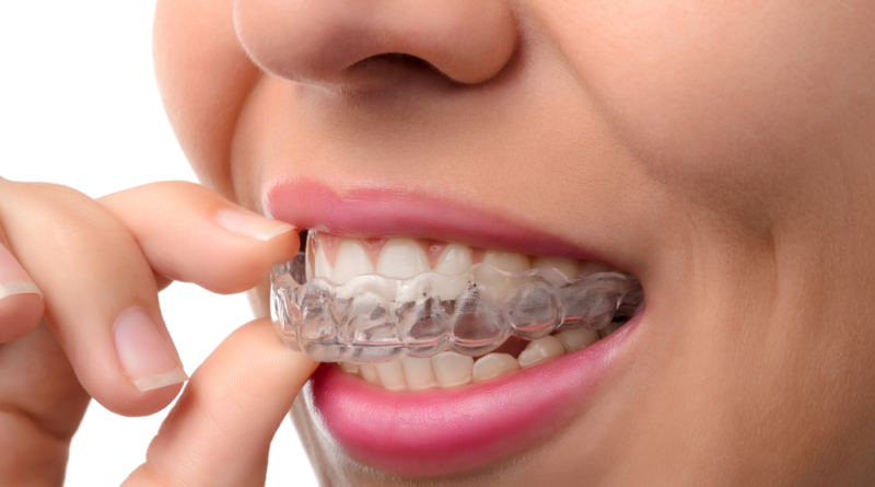 Who Can Get Invisalign and What Are the Benefits?