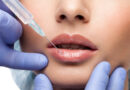 5 Incredible Advantages of Lip Fillers in Vancouver