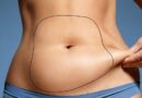 Liposuction