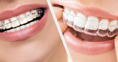 Important Considerations for Orthodontic Treatment in Shreveport- LA - 2023 - TrendMut